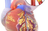 कशी टाळू शकता हृदय शस्त्रक्रिया ?